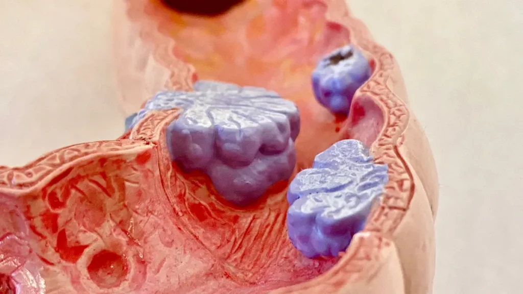 Anatomical model of a colon with several raised purple growths on its inner wall
