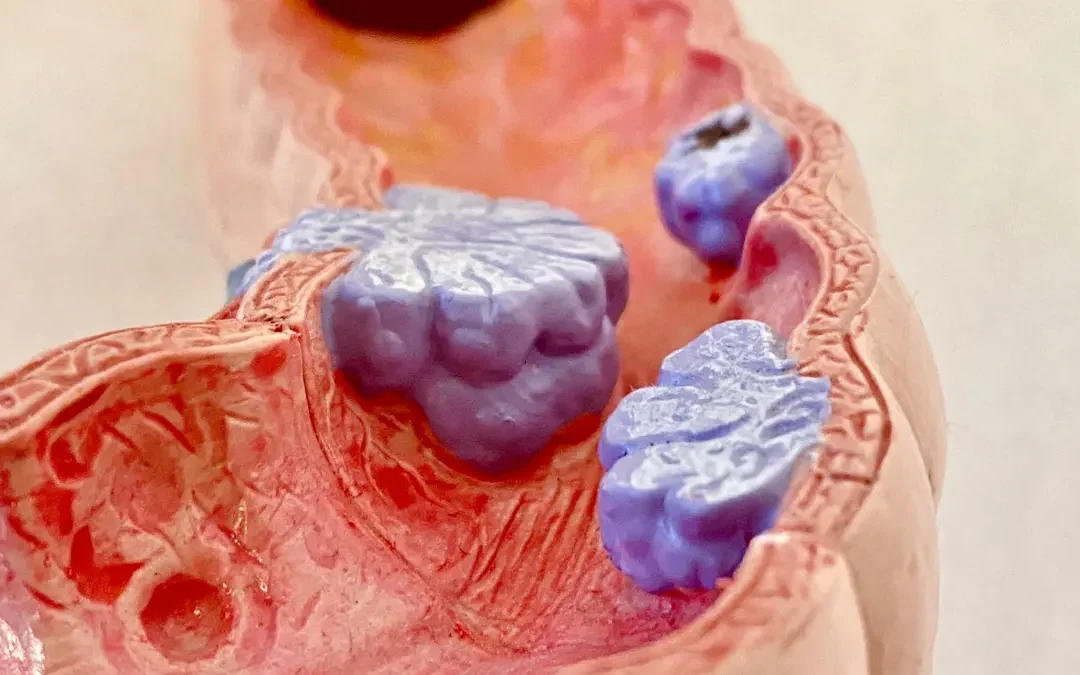 At Home Colon Cancer Test vs. Colonoscopy: What to Know